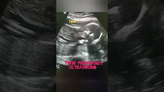 Twin Pregnancy Ultrasound at 20 weeks#fyp#viral#trending#shorts#foryou#ultrasound#subscribe#twins