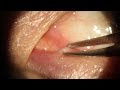 Removing permanent punctal plug silicone