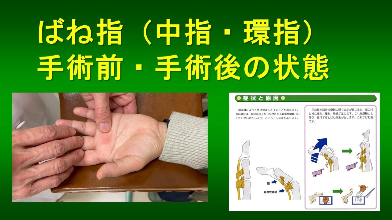 ばね指 手術前後の状態(2025.5症例提示) - YouTube