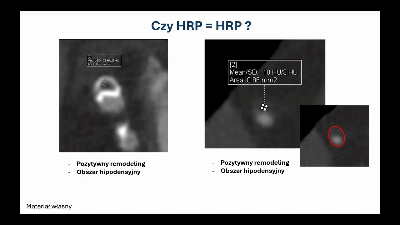 K. Sienkiewicz - Ocena morfologii i stabilności blaszki miażdżycowej.
