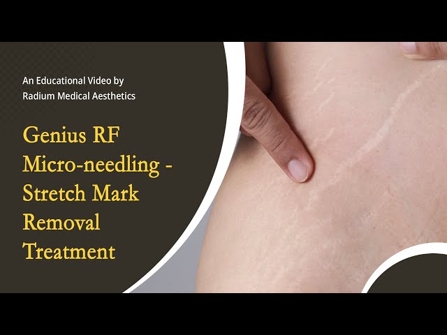 1 Powerful Stretch Mark Treatment With RF Microneedling