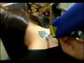 Laser Q-Switched Nd:Yag Rimozione Tatuaggio