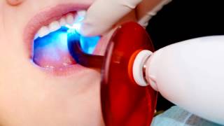 What are Dental Sealants?