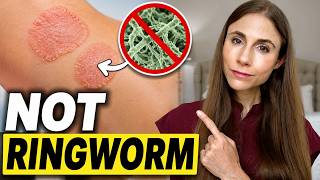 Ringworm or Eczema? How to Tell the Difference | Dermatologist Explains