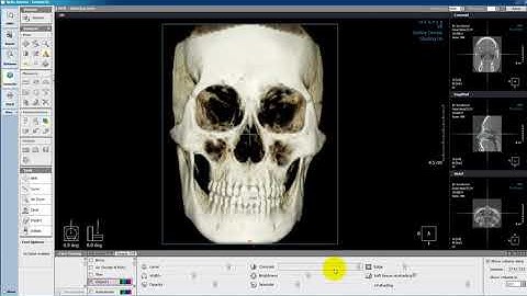 Xelis dental General Case Fine tuning Simple OTF