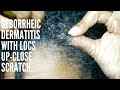 Sebborheic Dermatitis & Locs Up-Close Scratch