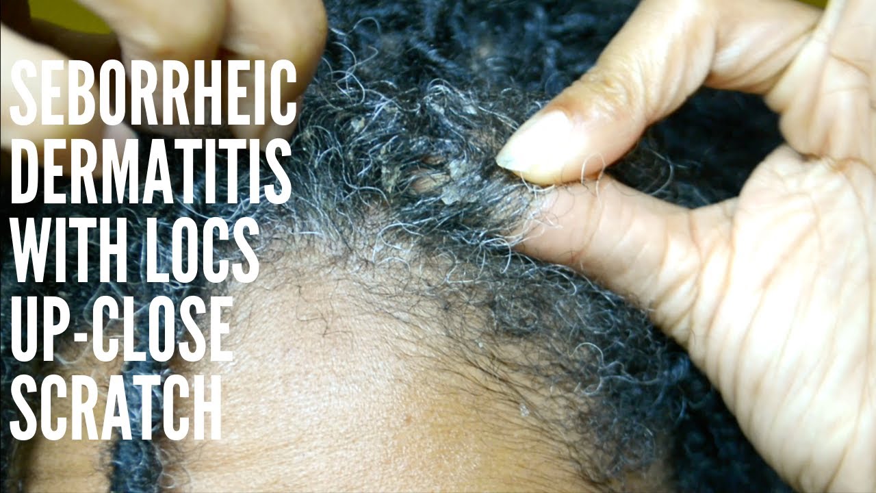 Sebborheic Dermatitis & Locs Up-Close Scratch - YouTube