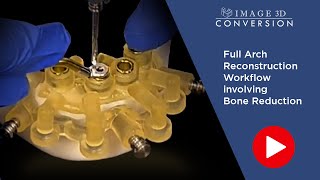 Full Arch Reconstruction Workflow Involving Bone Reduction