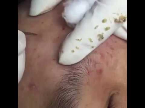 World of Blackheads - YouTube