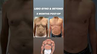 GYNECOMASTIA SURGERY & BEYOND SURGERY RESULTS: 5 MONTHS POSTOPERATIVE RESULTS #beforeandafter #gyno