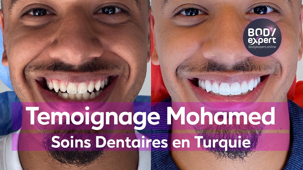 SOINS DENTAIRES | 🦷 Témoignage de Mohamed : 18 facettes dentaires Emax |  BODYEXPERT - YouTube