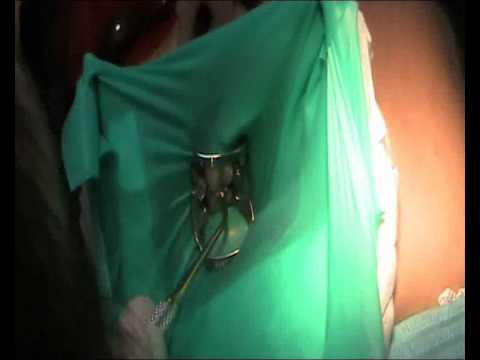 Cкрытый кариес. Hidden caries. Dental restoration.