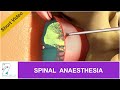 SPINAL ANAESTHESIA