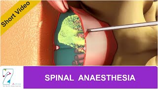 SPINAL ANAESTHESIA
