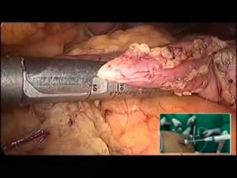 Laparoscopic Sleeve Gastrectomy By Dr. Parveen Bhatia