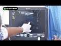 Tube Promedon Penile Implant Surgery | Day 4 Post-Op Scan Results