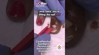 CorePendium Spotlight: Paronychia Incision and Drainage