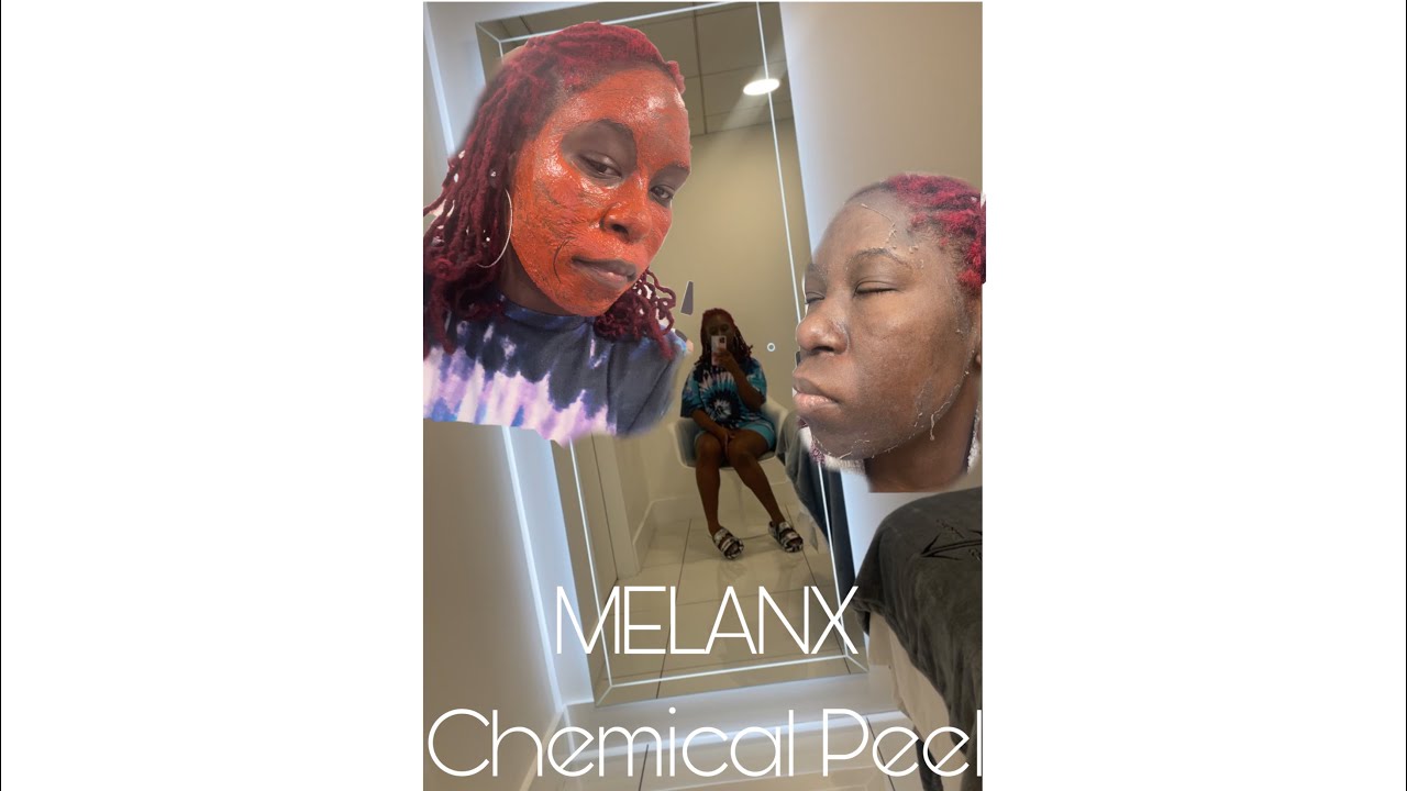 MelanX Chemical Peel Is It Worth 900? 🤔 YouTube