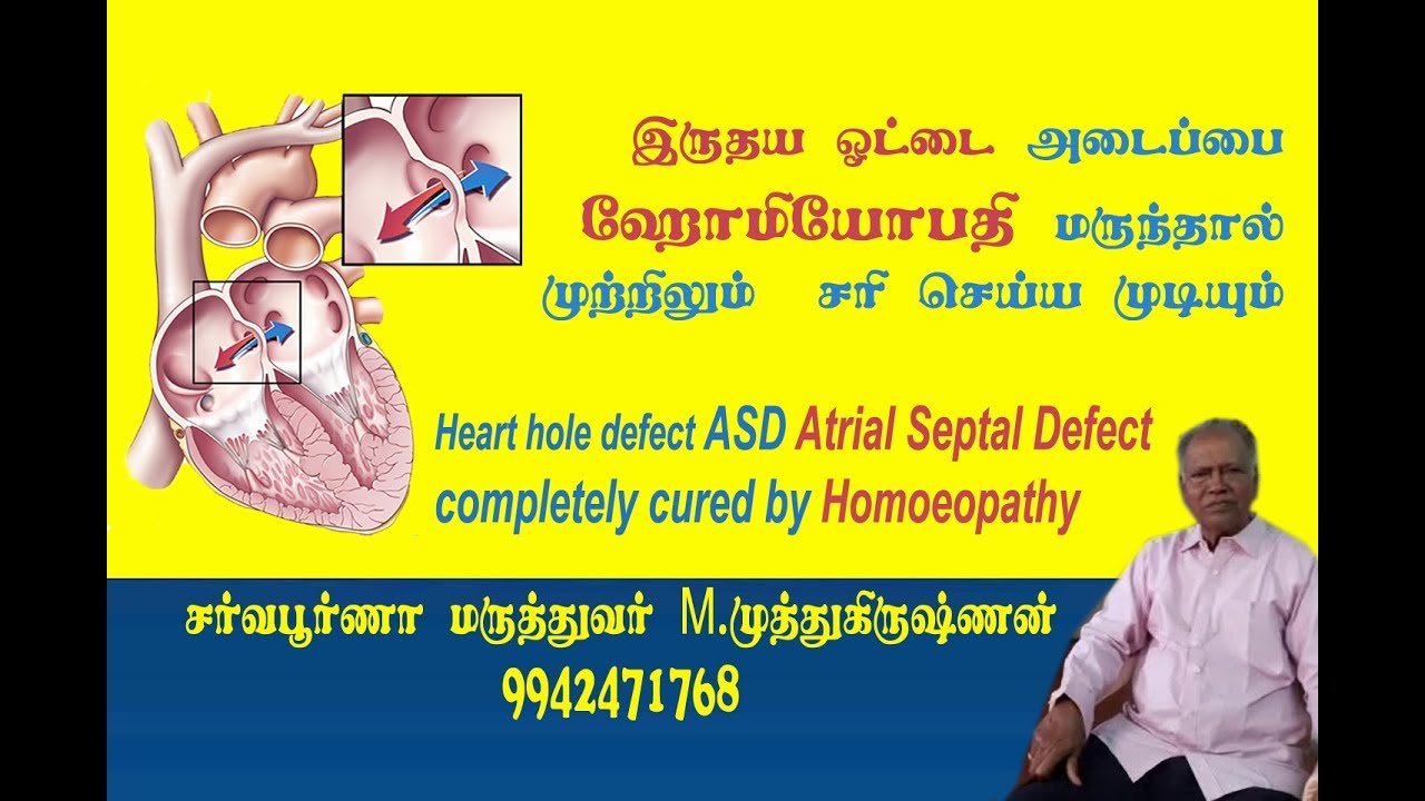 Heart hole defect ASD Atrial Septal Defect completely cured by