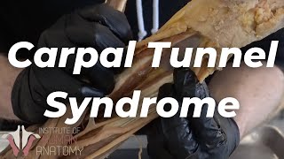 Carpal Tunnel Syndrome & the Median Nerve