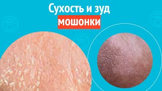 Сухость И Зуд Мошонки. Клинический Случай 1735