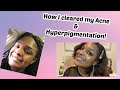 How I cleared my Acne &amp; Hyperpigmentation!