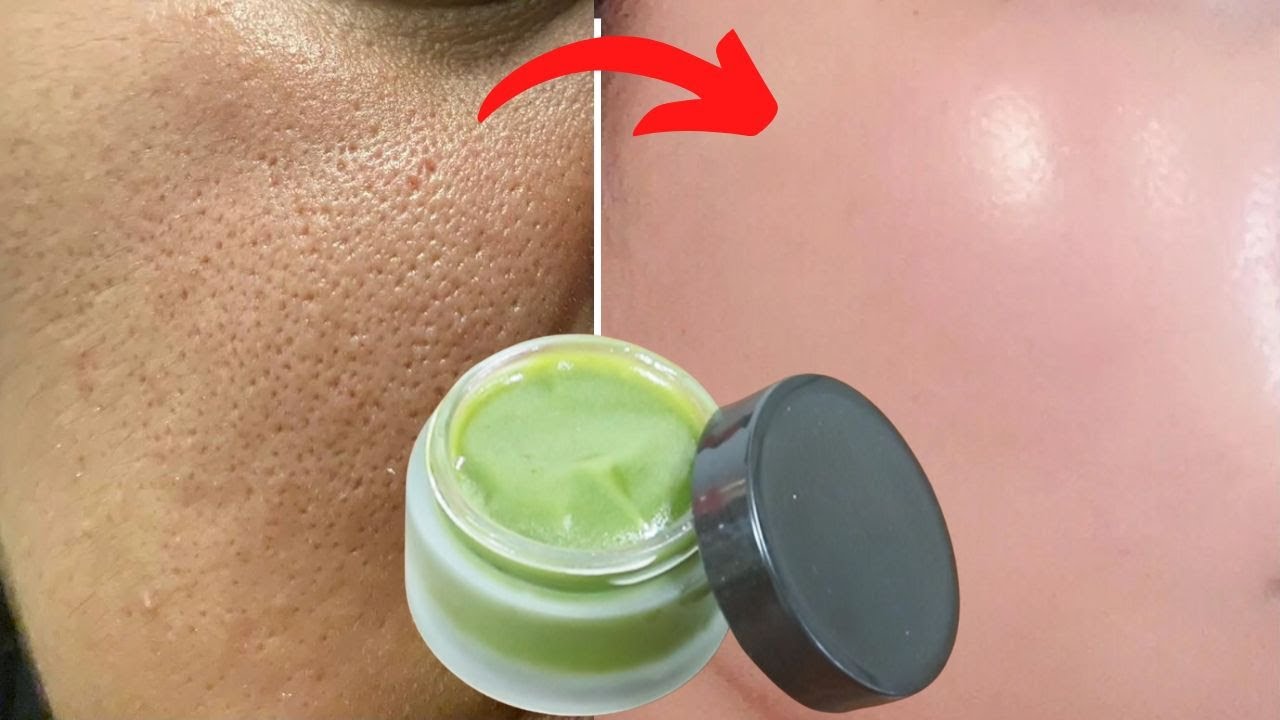 Хотите верьте, хотите нет, это лечение против морщин лучше, чем ботокс - близкие поры и отбеливая к