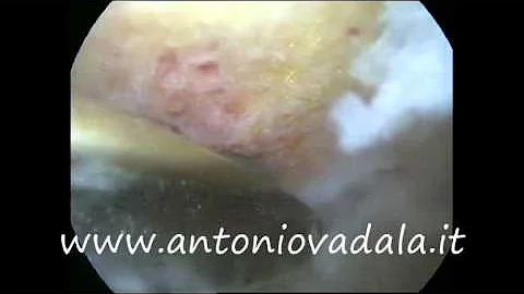 Come si cura la sindrome di impingement?
