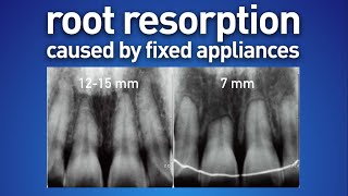 Root resorption caused by fixed appliances