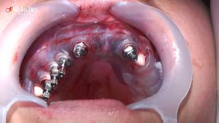 Guided surgery for immediate loading with a prefabricated provisional bridge | Alpha-Bio Tec