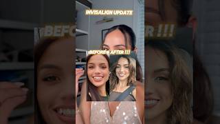 NO ONE TOLD ME THIS ABOUT INVISALIGN TREATMENT!