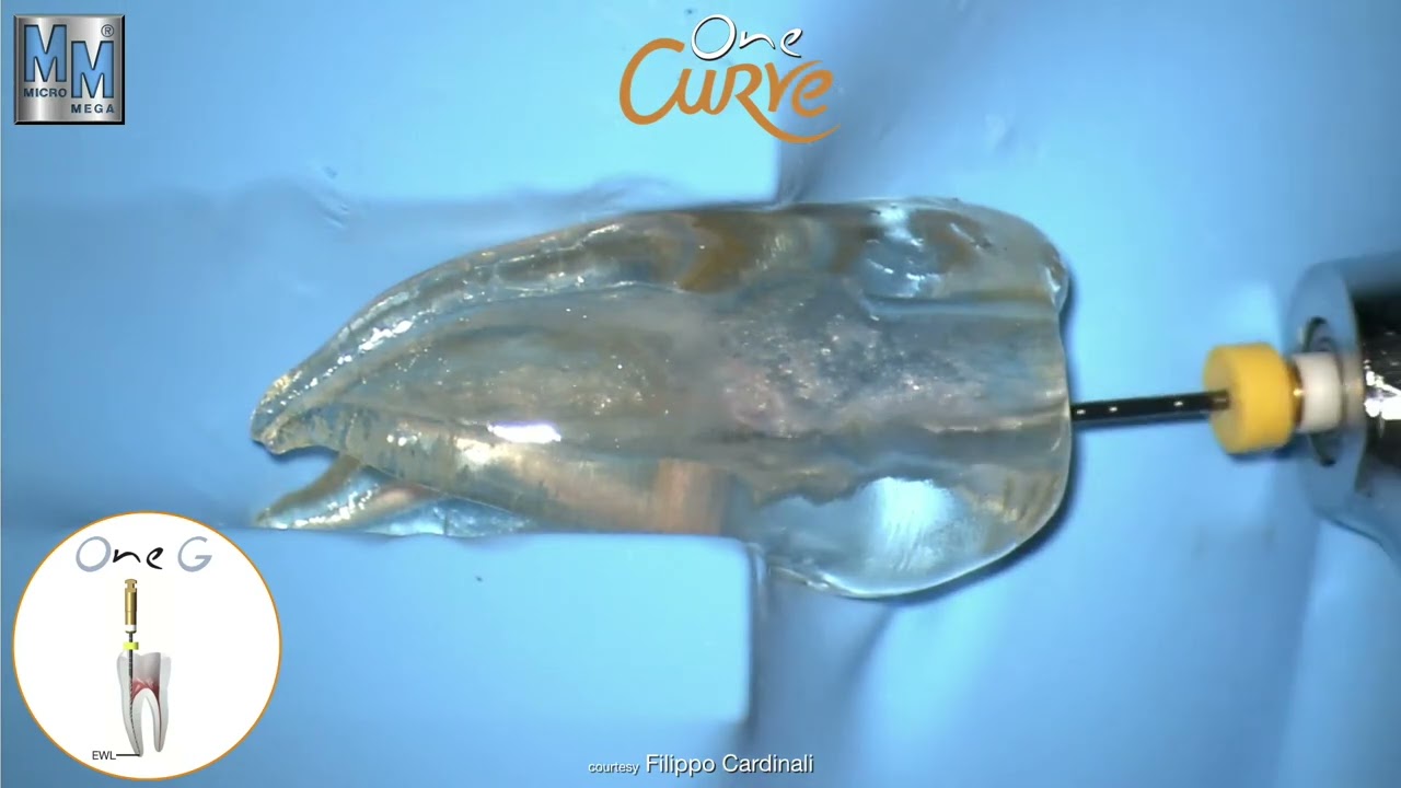 One Flare, One G, One Curve - MicroMega - Dr Filippo Cardinali   Italy