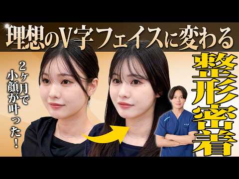 【整形密着】口横のもたつき＆顎下の脂肪を解消！たった2ヶ月で理想のVフェイスになれる1day小顔®︎の効果とは？
