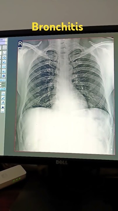 x-ray-chest-pa-bvm-broncho-vascular-marking-are-prominent-in-both