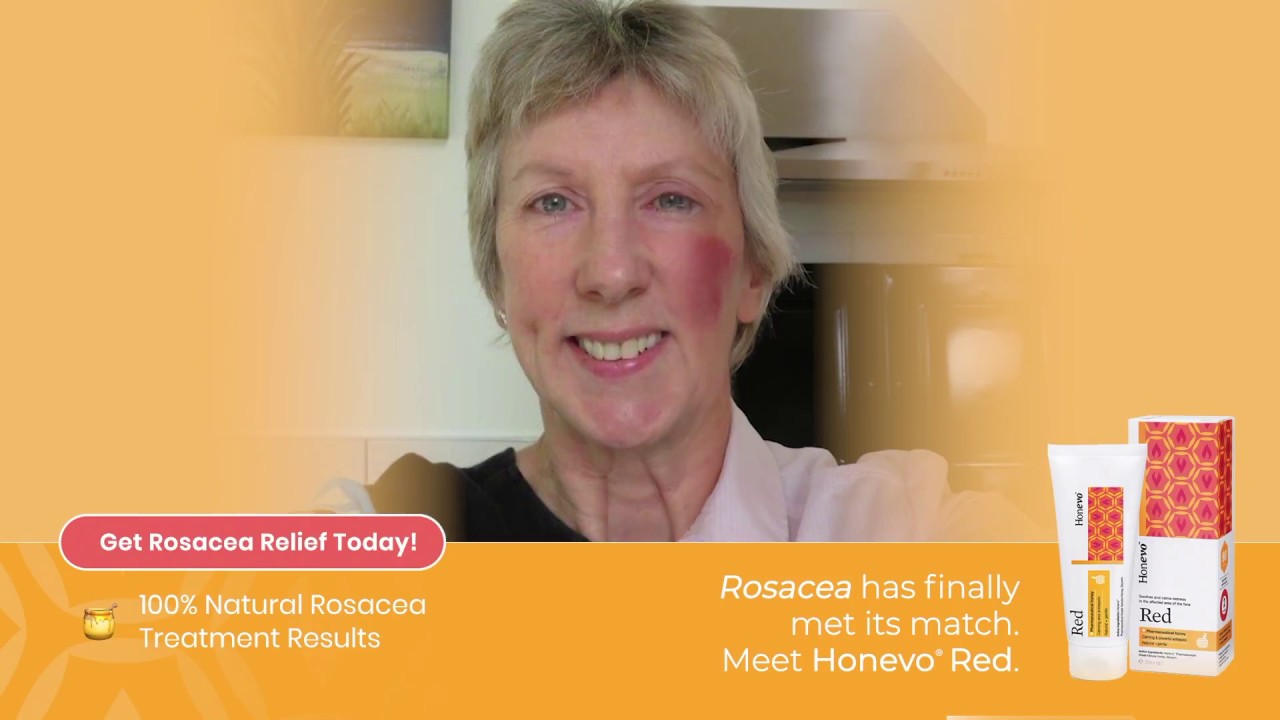 Amazing Rosacea Treatment Results (Honevo Red)