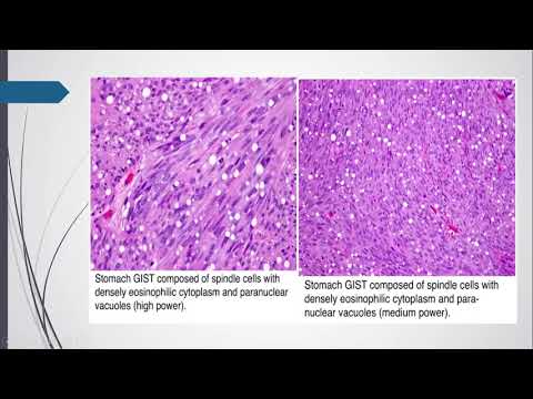 TUMOR DEL ESTROMA GASTROINTESTINAL