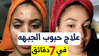 علاج حبوب الجبهه والوجه ( علاج حب الشباب في الجبهة للجنسين ) علاج الحبوب الحمراء تحت الجلد بالوجه