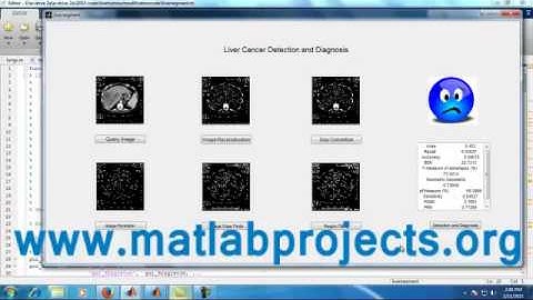 Liver Tumor Detection Image Processing Matlab Projects