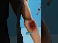 Why You Get a Bruise After an Injection (It’s Not the Needle You Think)