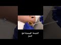 الشريحة الهرمونية لمنع الحمل مضمونة 100
