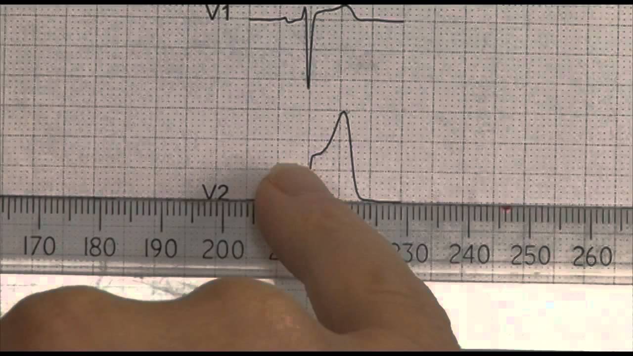 12 Lead EKG (ECG) STEMI examples - YouTube