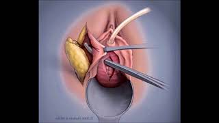 Urethrolysis And Martius Flap Graft For Recurrent Urinary Stress Incontinence With Fixed Urethra