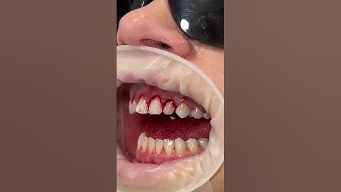 This technique is known as a gum lift, gum contouring or gum augmentation ✨