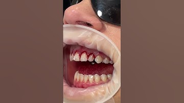Thumbnail of This technique is known as a gum lift, gum contouring or gum augmentation ✨