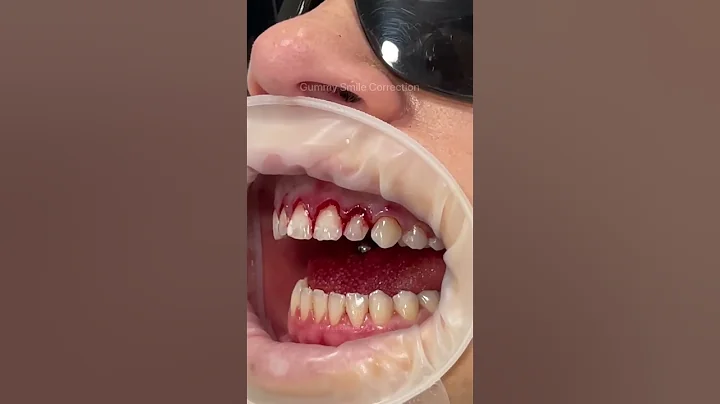 This technique is known as a gum lift, gum contouring or gum augmentation ✨ - DayDayNews