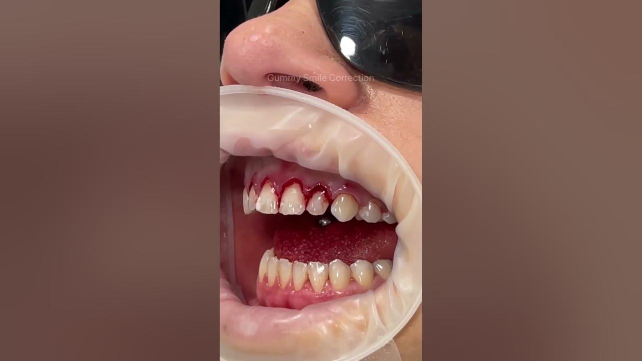 This technique is known as a gum lift, gum contouring or gum augmentation ✨