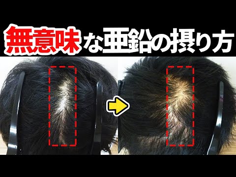 【逆効果】亜鉛の吸収を妨げる飲み物・食べ物を発毛のプロが解説【薄毛対策】