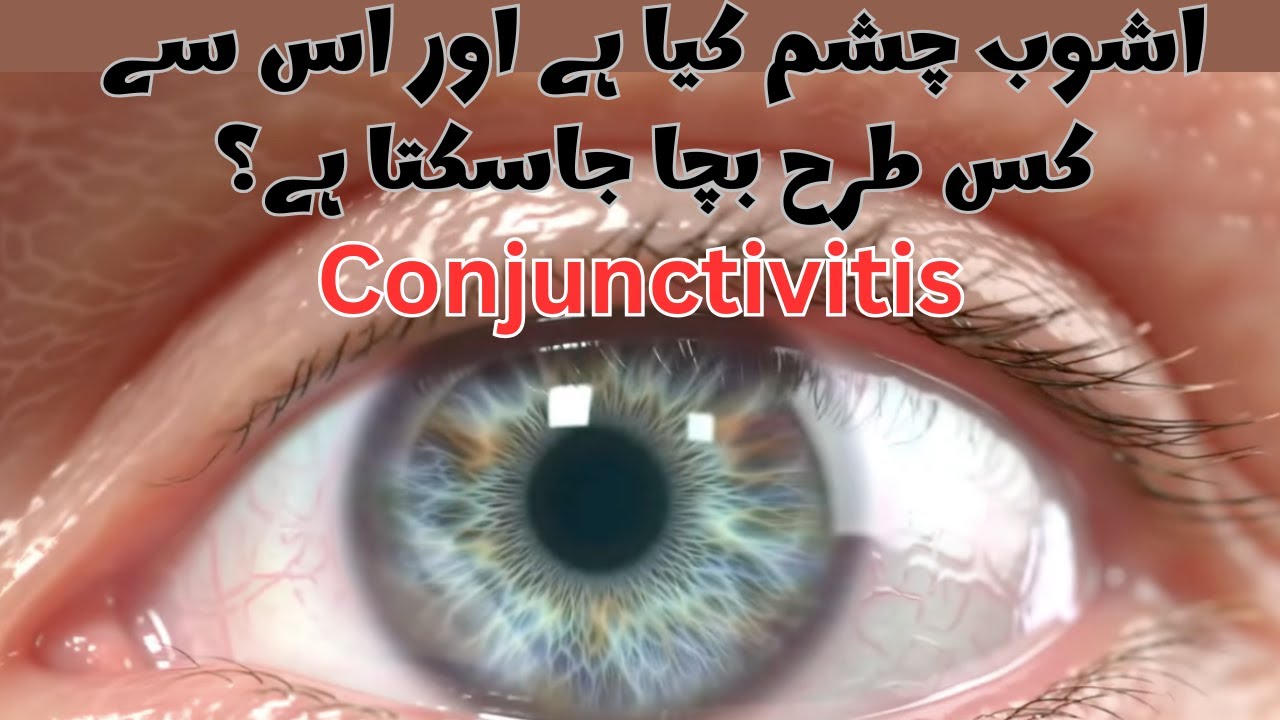 آشوب چشم: علامات، وجوہات، علاج | ProLearn360۔  Conjunctivitis , commonly known as pink eye