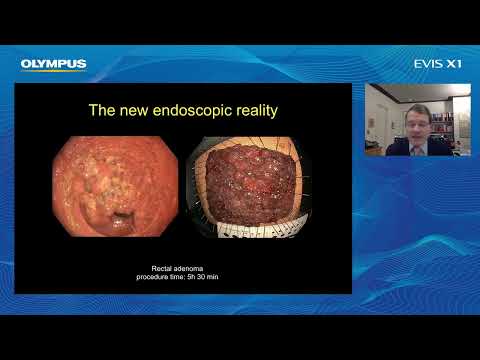 ESD with EVIS X1 Imaging technologies - Meet the Expert