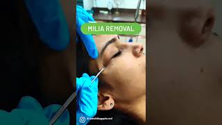 Milia Removal Dr Sanchika Gupta 